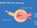 당뇨 신장병증