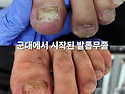 군포 무좀발톱, 군대있을때 부터 계속 조금씩 진행되었다고 하는 40대 남..