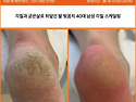 안양 범계 딱딱해지며 갈라지는 발각질제거
