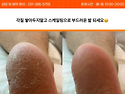 범계, 여름철 남자 발각질 관리로 부드러운 발 만드세요!