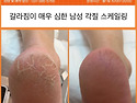 (안양 범계) 뒷꿈치가 심하게 갈라지는 발각질 관리