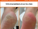 안양 범계 딱딱한 굳은살과 발각질 깔끔하게 관리하기