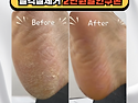 마포 발각질, 발각질제거 할인쿠폰 받아가세요.