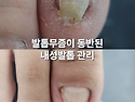 산본 내성발톱, 발톱무좀이 동반된 50대 여성 내성발톱 관리