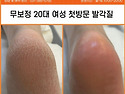안양 범계 20대 여성 발각질관리로 아가발 만들기^^