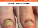 범계 발톱무좀, 포디랩의 꾸준한 관리로 개선된 발톱무좀 전후
