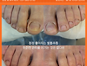 안양 범계 꾸준한 관리로 달라지지고 있는 발톱무좀