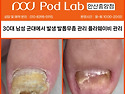 안산 고잔동 발톱무좀, 군대에서 부터 시작된 30대 남자 발톱무좀