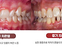 치아 이빨이 흔들리는 치주염 , 잇몸염증 임플란트 전후 특수자석 치료법