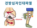 전방십자 인대 재활 및 도수치료 - 자료 나눔해 드립니다 ^^