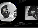 폐 고주파 절제술(Lung Radiofrequency Ablation, Lung RFA) 국소 비수술적 열치료 ̴