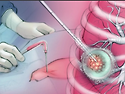 미국에서의 폐 고주파 절제술 (Lung Radiofrequency Ablation, Lung RFA) 사례