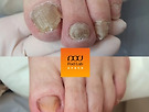 원주 무좀발톱 스..