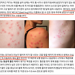 빈대 만만하게 볼놈이 아니다 이미지