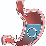소화불량을 완치하는 새로운 시술법 이미지