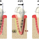 진심 이게 가능하다고...? 싶은 치아교정 원리...jpg 이미지