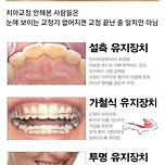 끝나도 끝난 게 아니다... 치아교정이 힘든 이유 ㅠㅠ 이미지