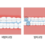 치아 교정 결정 시 사람들을 엄청 큰 고민에 빠트리는 것 이미지