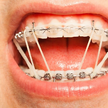 치아 교정 기간 중 제일 귀찮은 단계 이미지