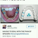 치아교정시 겪는 것 이미지