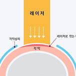 솔직히 진짜 신기한 라식•라섹 수술...jpg 이미지