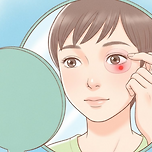 눈 실핏줄 터짐, 결막하출혈 원인과 자연 치유 기간 이미지