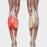 종아리 뒤쪽 통증의 원인과 걸을 때 나타나는 오른쪽·왼쪽 종아리 통증의 이유 이미지
