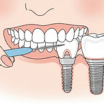 임플란트 수명 늘리는 관리법, 치간칫솔 사용이 필수인 이유 이미지