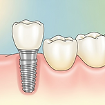 임플란트 수명 10년 관리만 잘하면 평생 쓴다 이미지