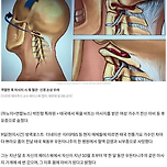 목 비트는 마사지 받은 태국 여성가수가 전신마비 등 후유증으로 사망 이미지