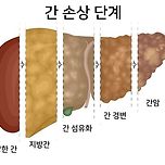 간 손상 단계.jpg 이미지