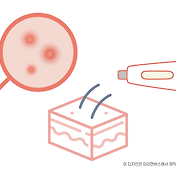 갑상선 호르몬 약물들 정리 - 안티로이드, 메티마졸, 씬지로이드, 콤지로이드