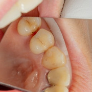 치과에서 치료 안 하는 충치가 있다? '정지우식'이란?