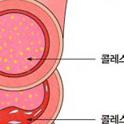 혈관벽에 붙은 콜레스테롤을 제거하자 [운동설계]