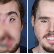 의료진 100여 명 뛰어든 안면이식..새 삶을 선물하다