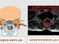 협착증, 수술없이 치료 가능합니다