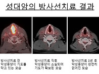 성대암의 방사선치료