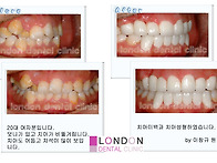 치아교정을 대체하는 라미..