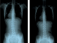 특발성 척추측만 교정 사진
