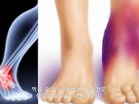 발목통증의 원인