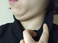 턱수술후기