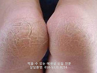 발뒤꿈치 각질의 원인