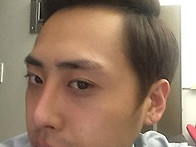 재수술 후기 [ L자실리콘 ..