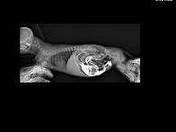 내림결장 하부와 직장 단락(결잘과 직장 문..