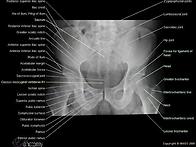 x-ray(pelvic)