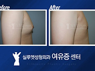 여유증 일반적인 남자가슴..
