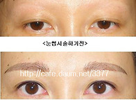 예전의 잘못된 문신제거후..
