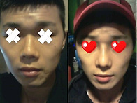 콧대교정 들창코 평가부탁..
