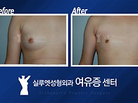 여유증 수술 병원 선택