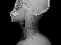 경추 퇴행성 디스크 질환